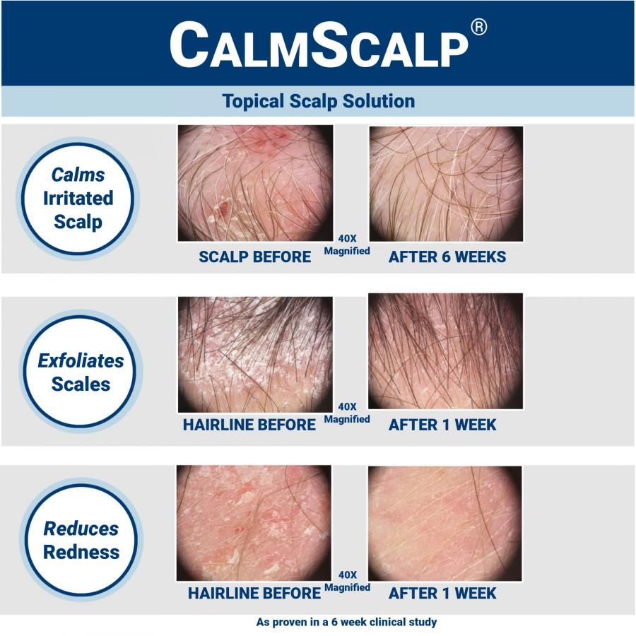 Xenna Announces Clinical Study Results for its CalmScalp(R) Topical Solution for Irritated Scalp and Hairline