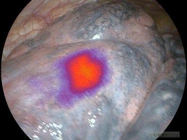 Integro Theranostics announces positive Phase 1b clinical trial data, advancing CXL into Phase II Study