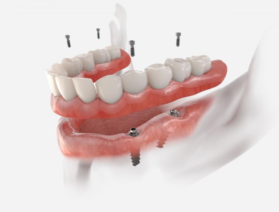 Oxnard Dental Experts Offer All-on-X Dental Implant Solutions for Full Smile Makeovers